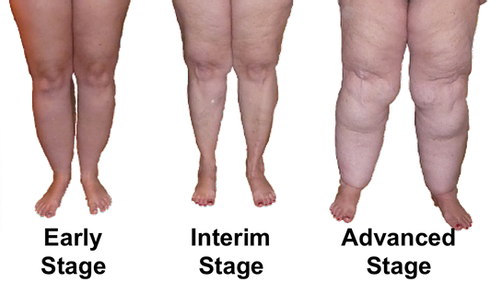 Lipedema Stages