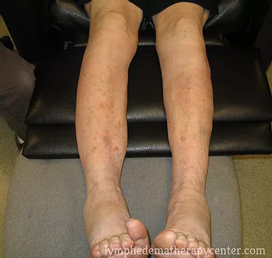 Post Edema Treatment