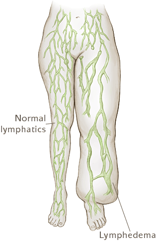 What is Lymphedema